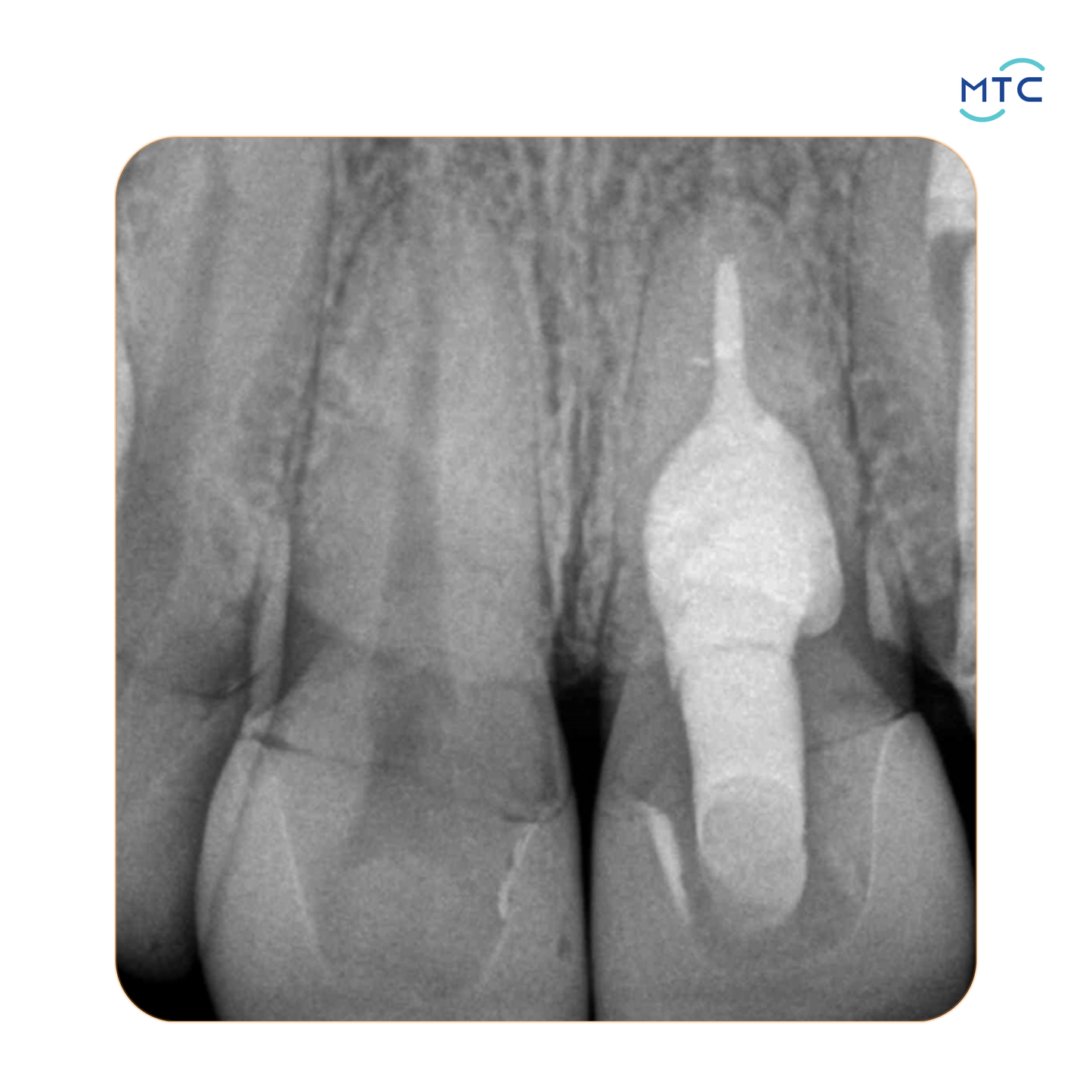Angelus Bio-C Repair بايوسيراميك بُتي