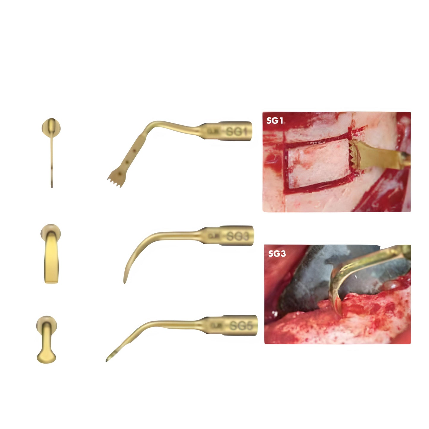 Ultrasonic bone surgery system & nbsp