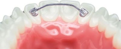 Lingual Retainers