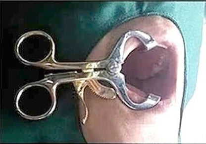 Exlin Molt Mouth Gag ( mouth opener ) Dental Supplies