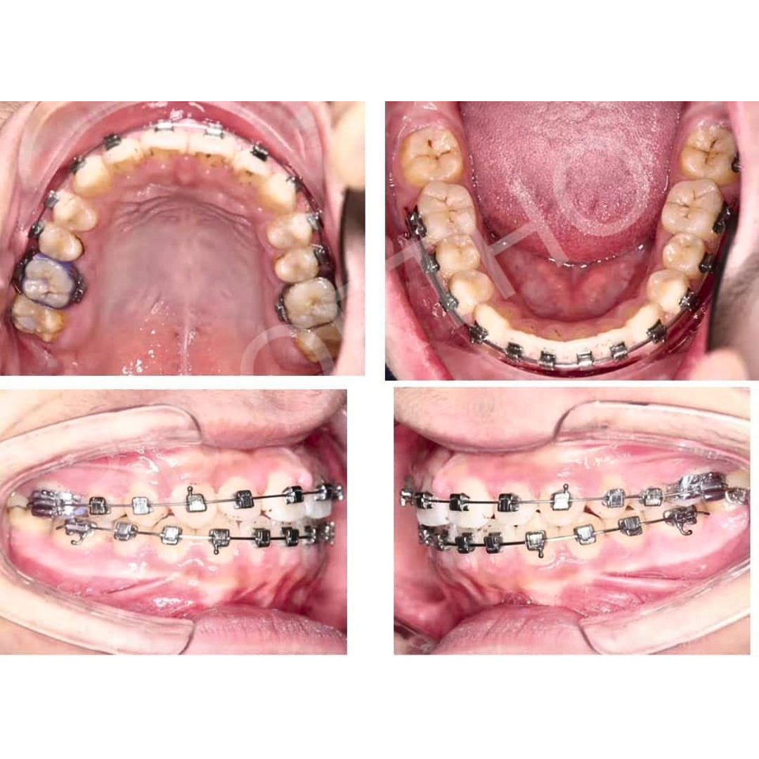 Self Ligating bracket (Passive) سيلف لايكيتنك براكيت