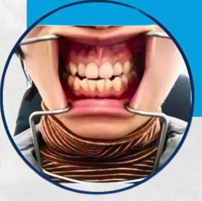 Exlin Origner Cheek Lip Retractor