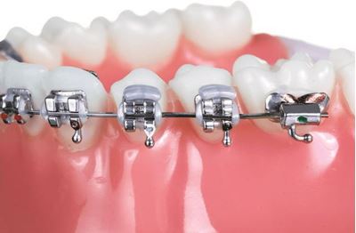 IOS Bracket Guard Elastic - PK/100 Orthodontic Brackets