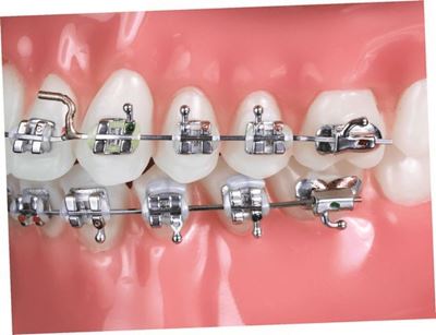 IOS Bracket Guard Elastic - PK/100 Orthodontic Brackets