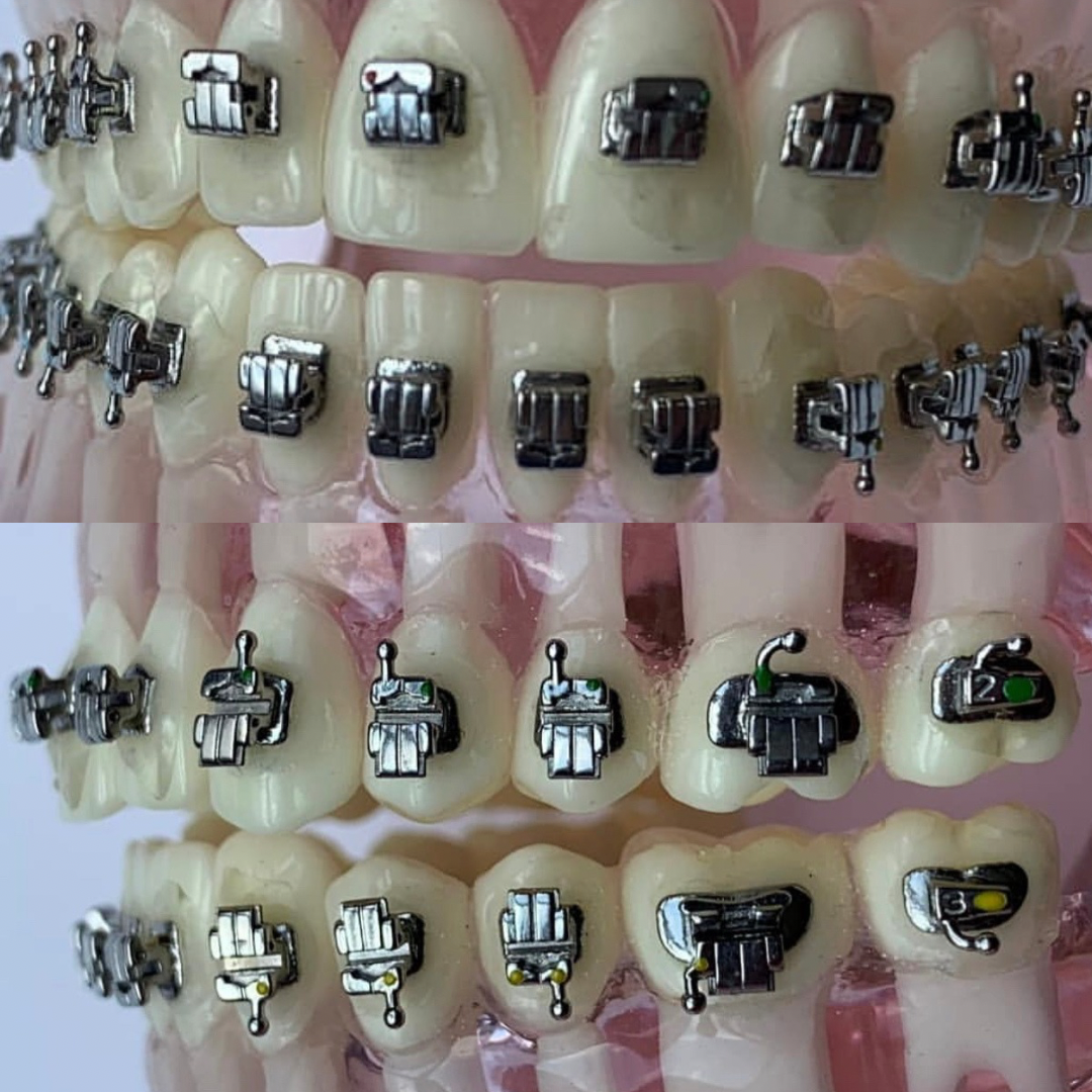 Self Ligating bracket (Passive) سيلف لايكيتنك براكيت