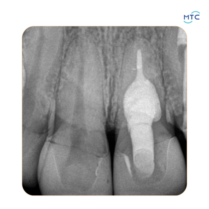 Angelus Bio-C Repair Bioceramic Repair Material