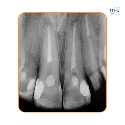 Angelus Bio-C Sealer Bioceramic Root Canal Sealer