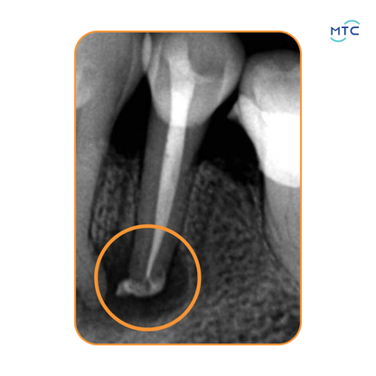 Angelus Bio-C Sealer Bioceramic Root Canal Sealer