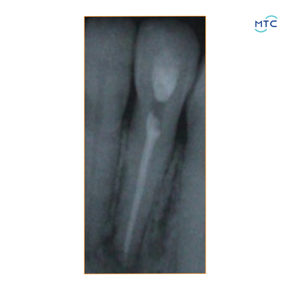 Angelus Bio C Temp Intracanal Medication