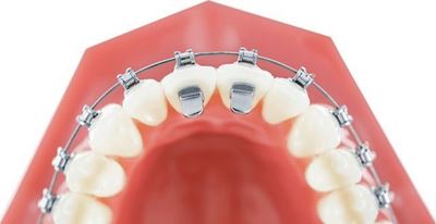 IOS Bite Wings - PK/10 Orthodontic Supplies