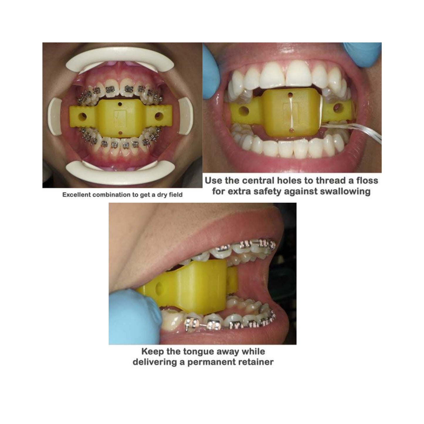 Disposable Tongue Block