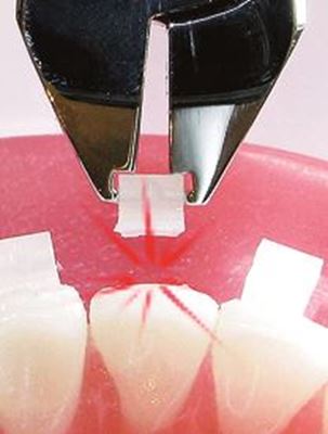 IOS Ceramic Bracket Debonding plier Orthodontic Plier
