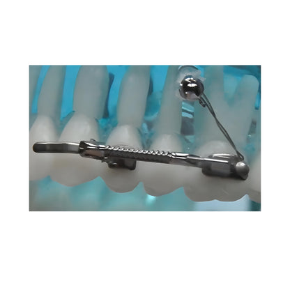 SUMITECK Molar Distalizer Orthodontic Supplies
