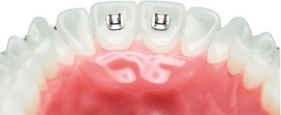 IOS Tongue Spikes - PK/10 Orthodontic Supplies