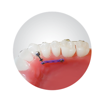 IOS Tree Hook - PK/ 10 Orthodontic Auxiliary